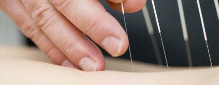 physical-therapy-clinic-dry-needling-fairfield-universal-therapy-fairfield-ia